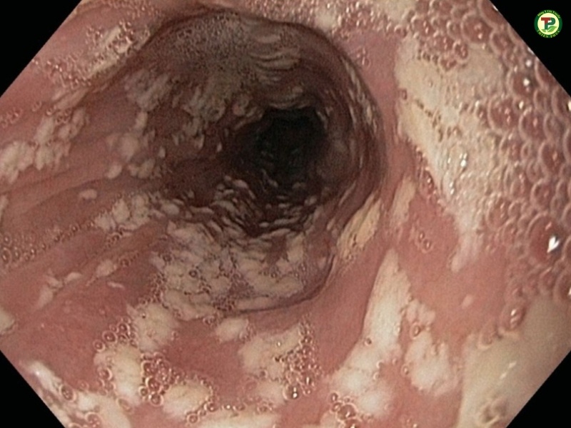 Nấm lan xuống vùng hầu họng gây viêm họng gây ho và đau rát họng.